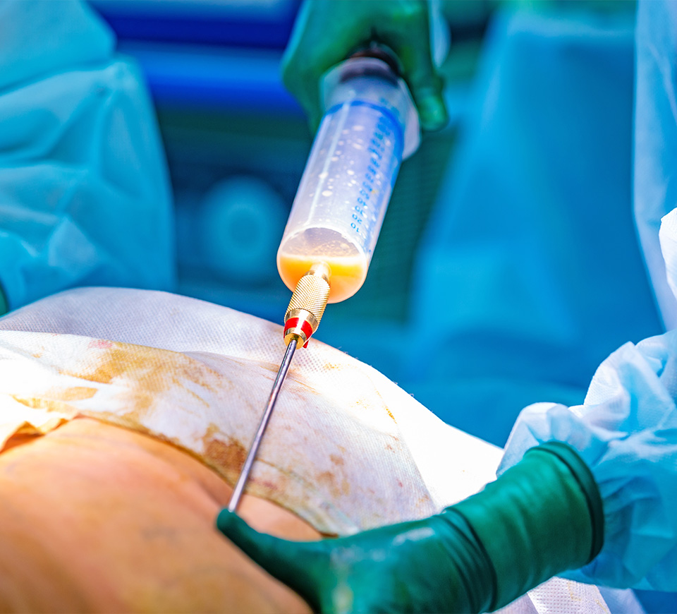 lipoaspiration vaser