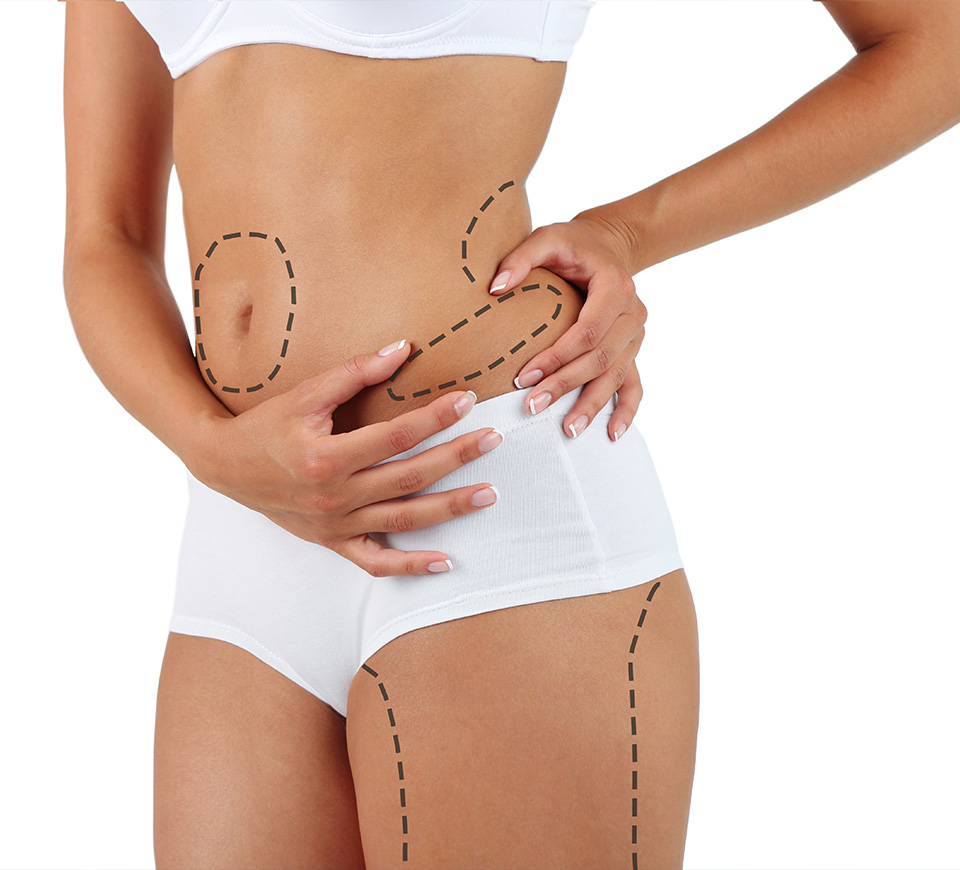 liposuccion