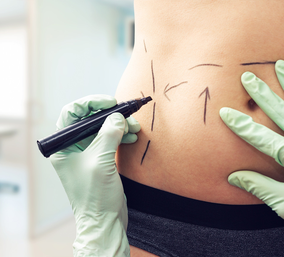 opter pour une liposuccion