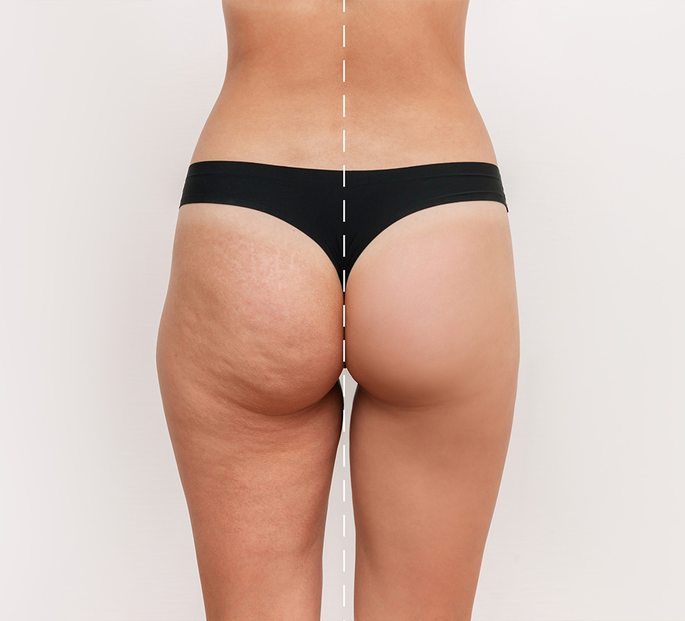 renuvion cuisses