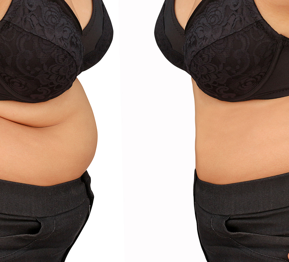 resultats liposuccion