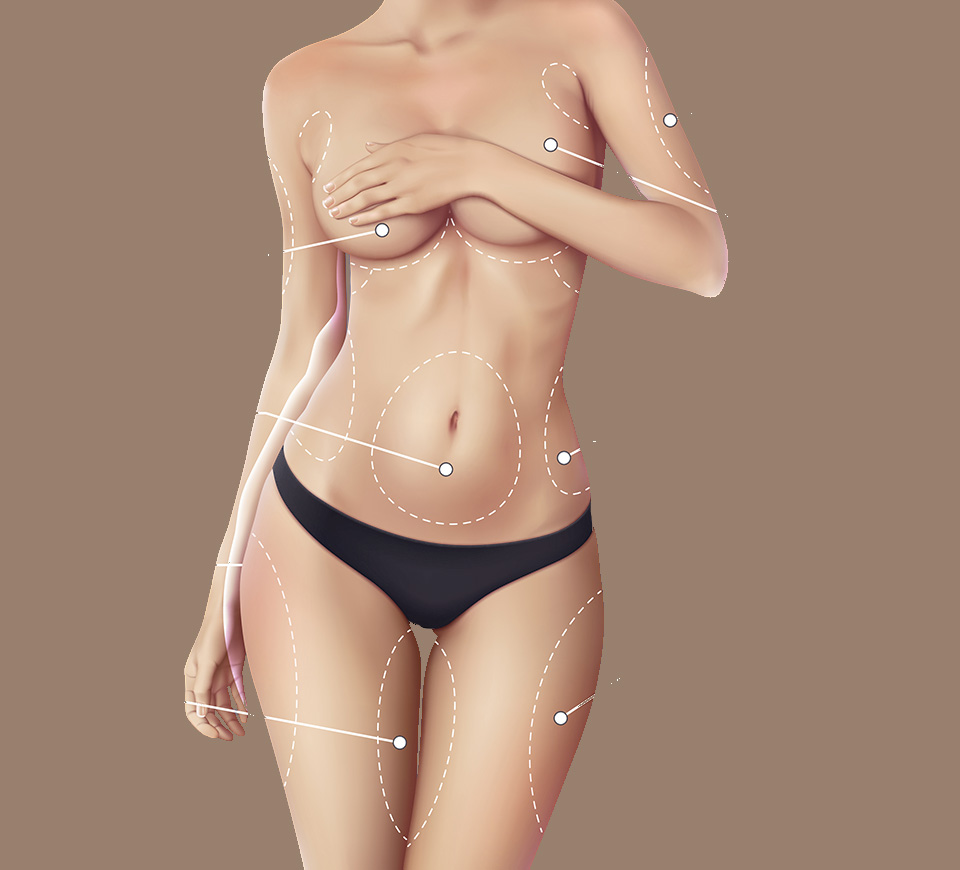zones liposuccion