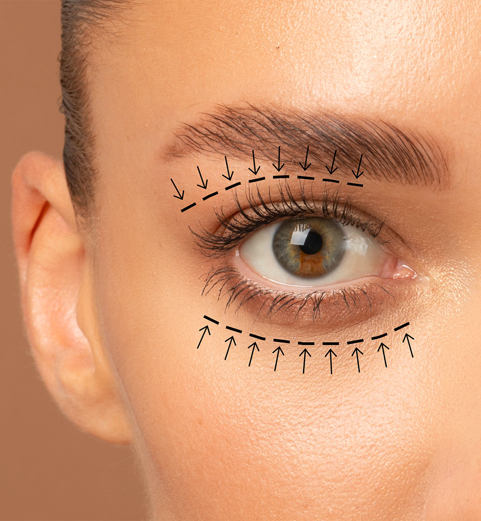 blepharoplastie