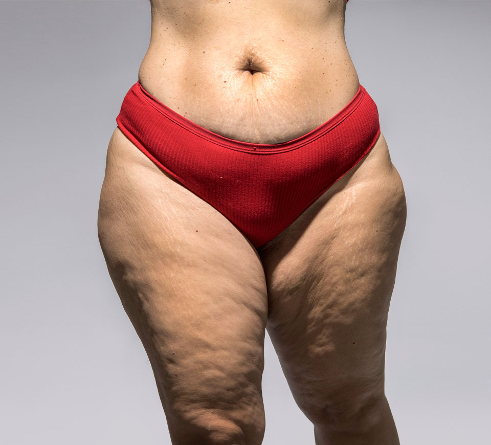 bodylift inferieur
