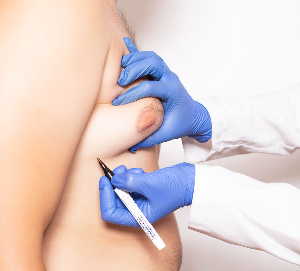 gynecomastie