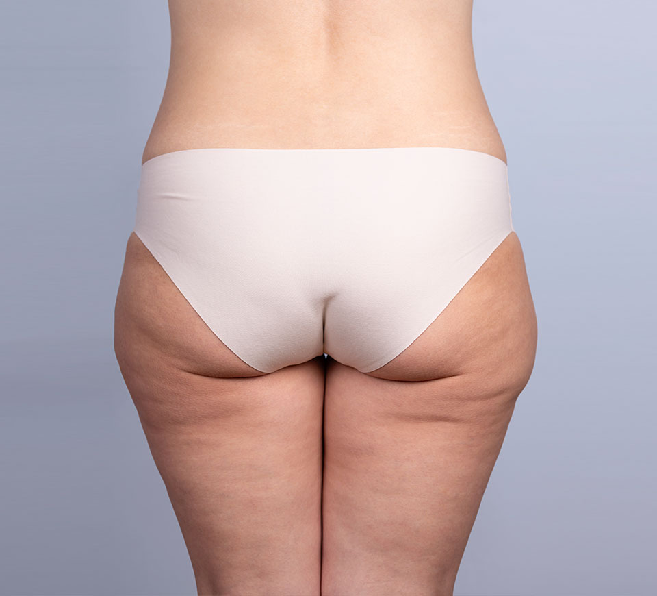 Résultat bodylift inferieur