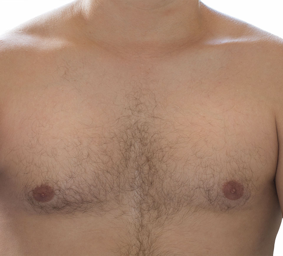 resultat gynecomastie