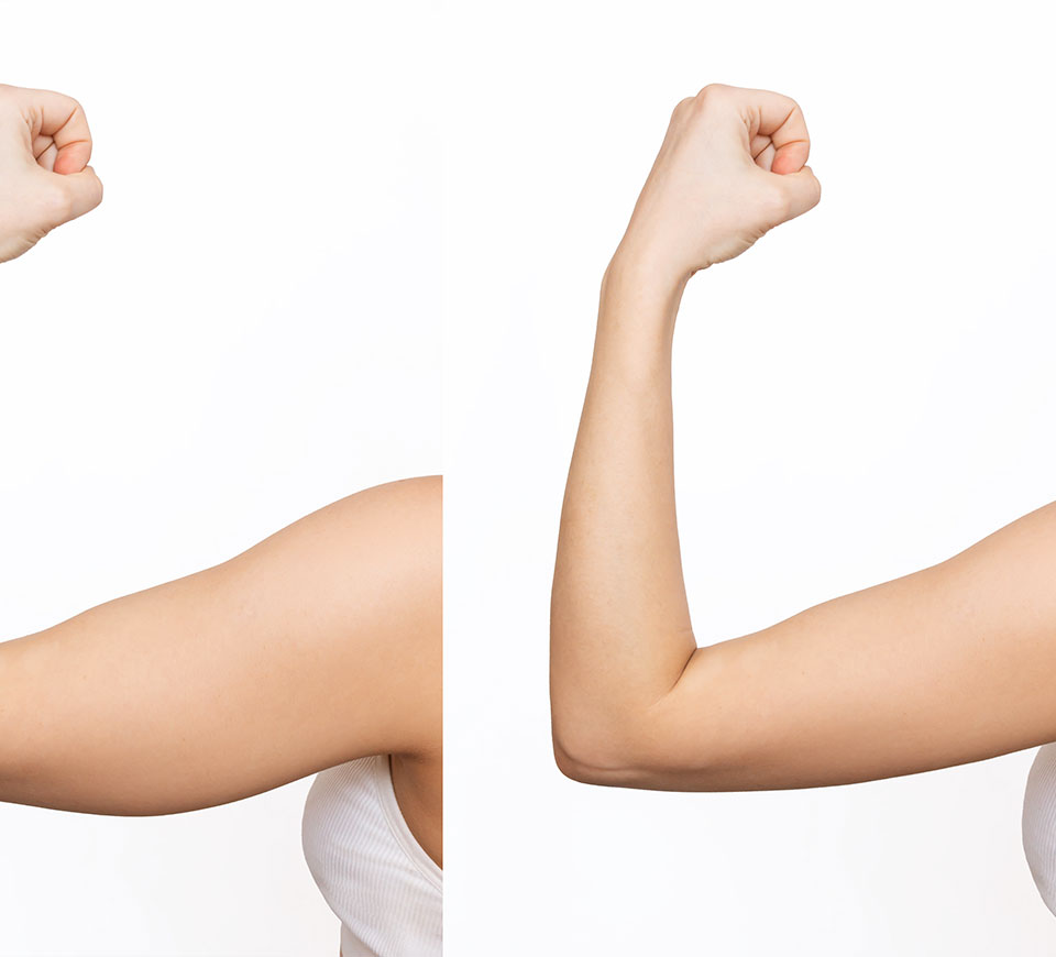 resultats du lifting des bras