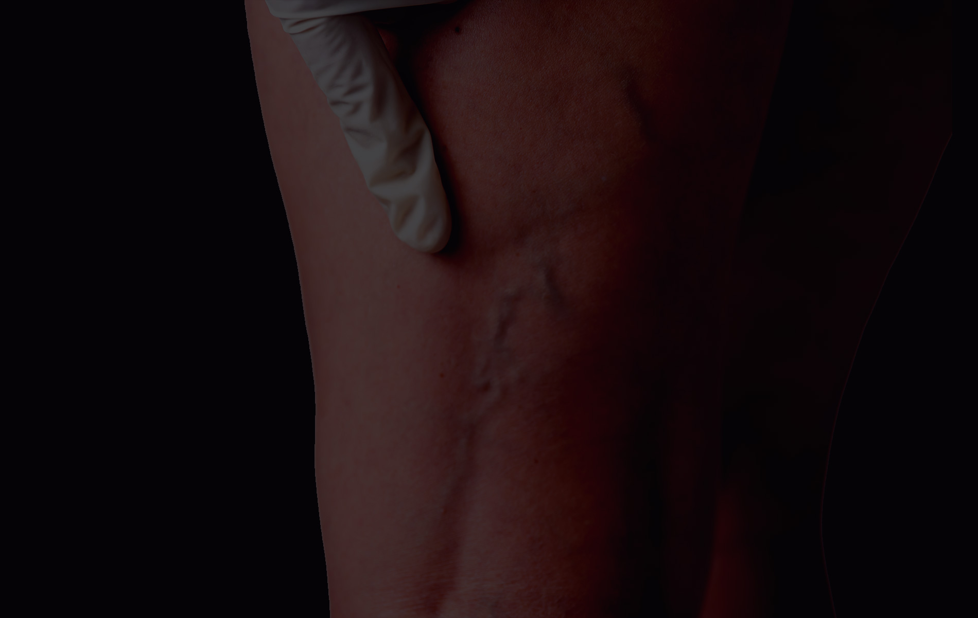 Laser vasculaire