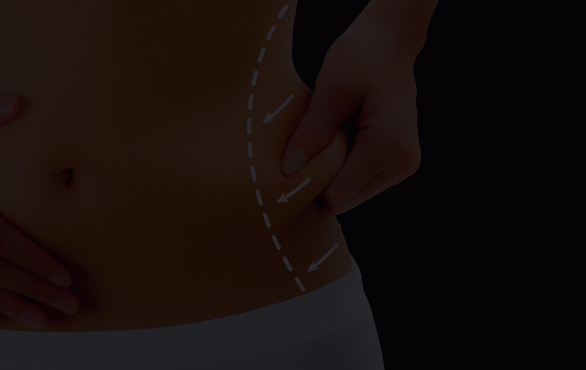 Lipoaspiration des flancs