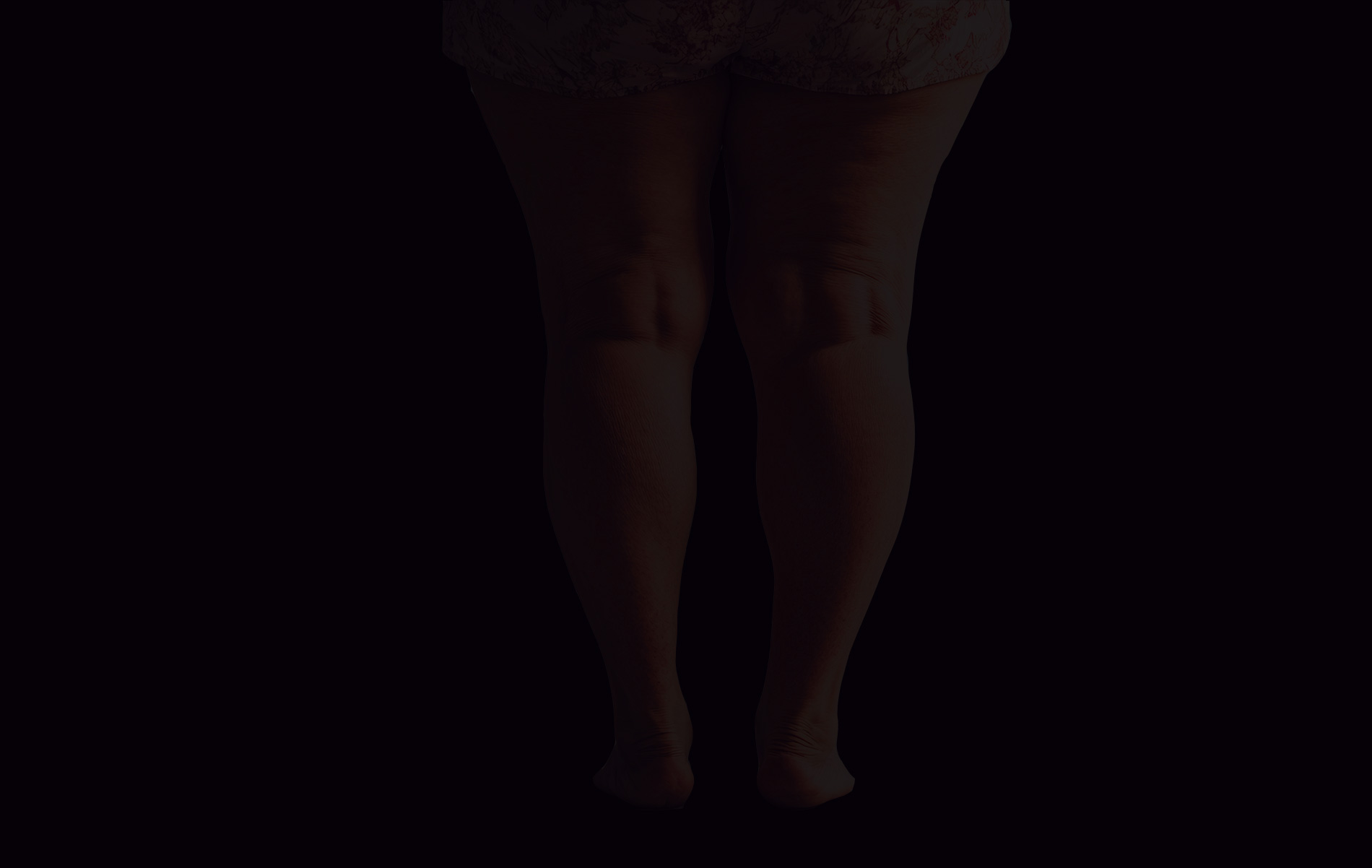 Lipoedème