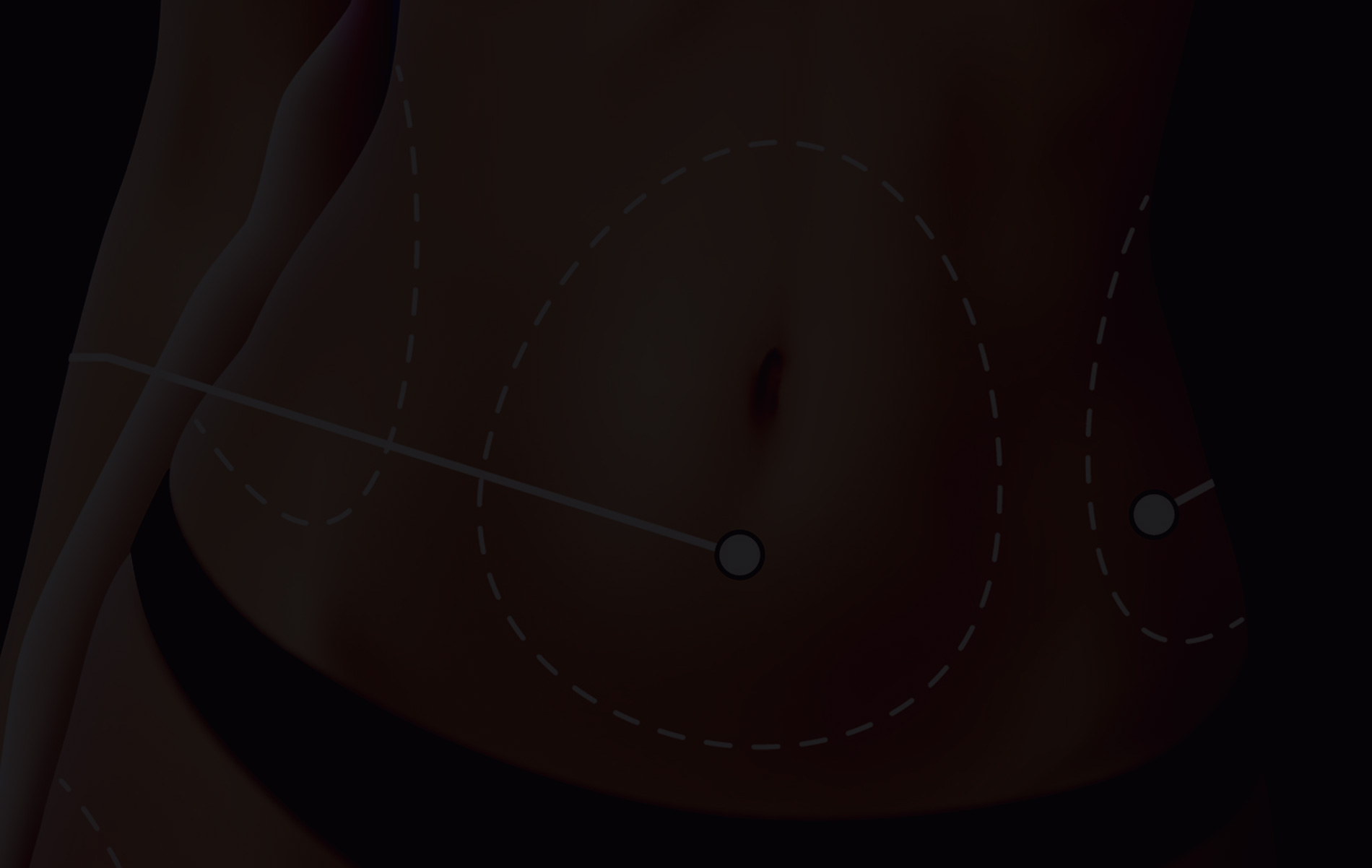 Lipoaspiration du ventre