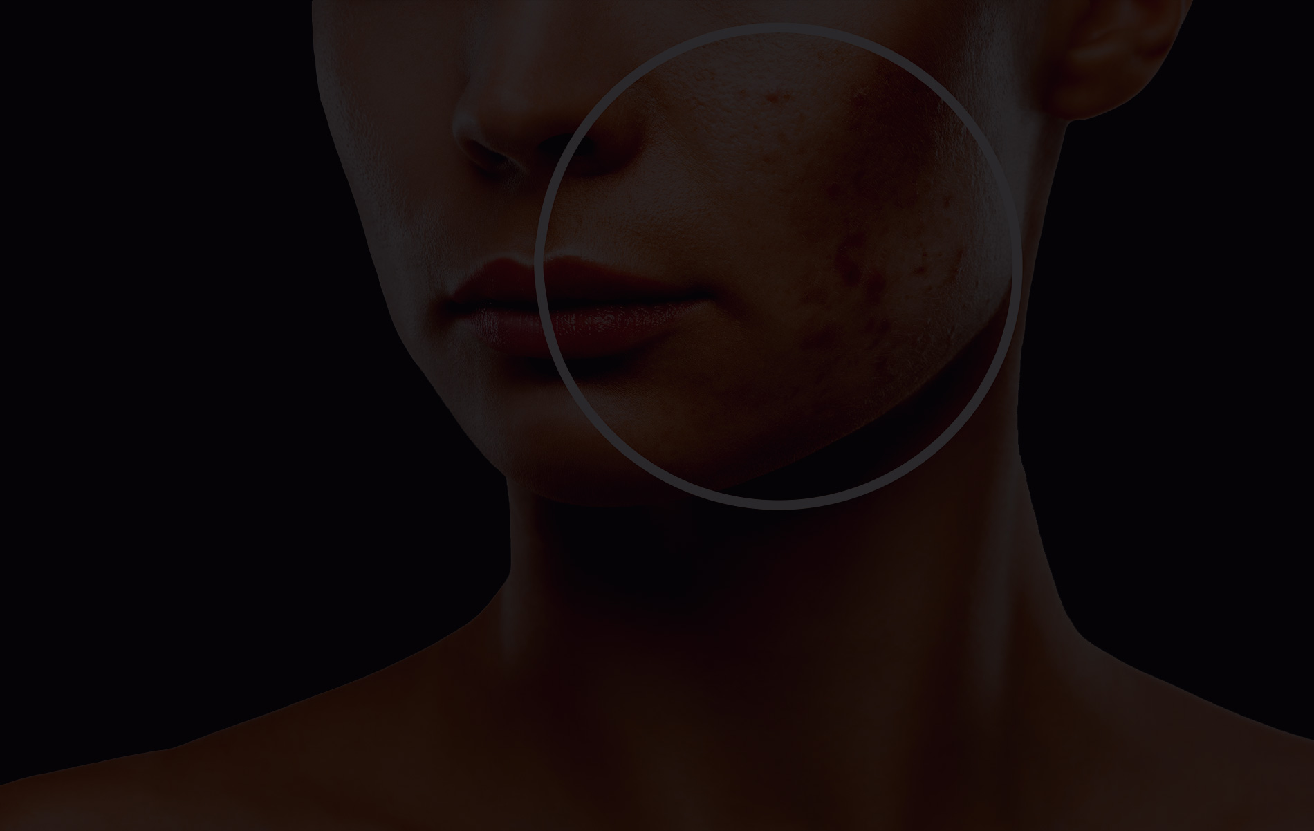 Avant un resurfaçage laser
