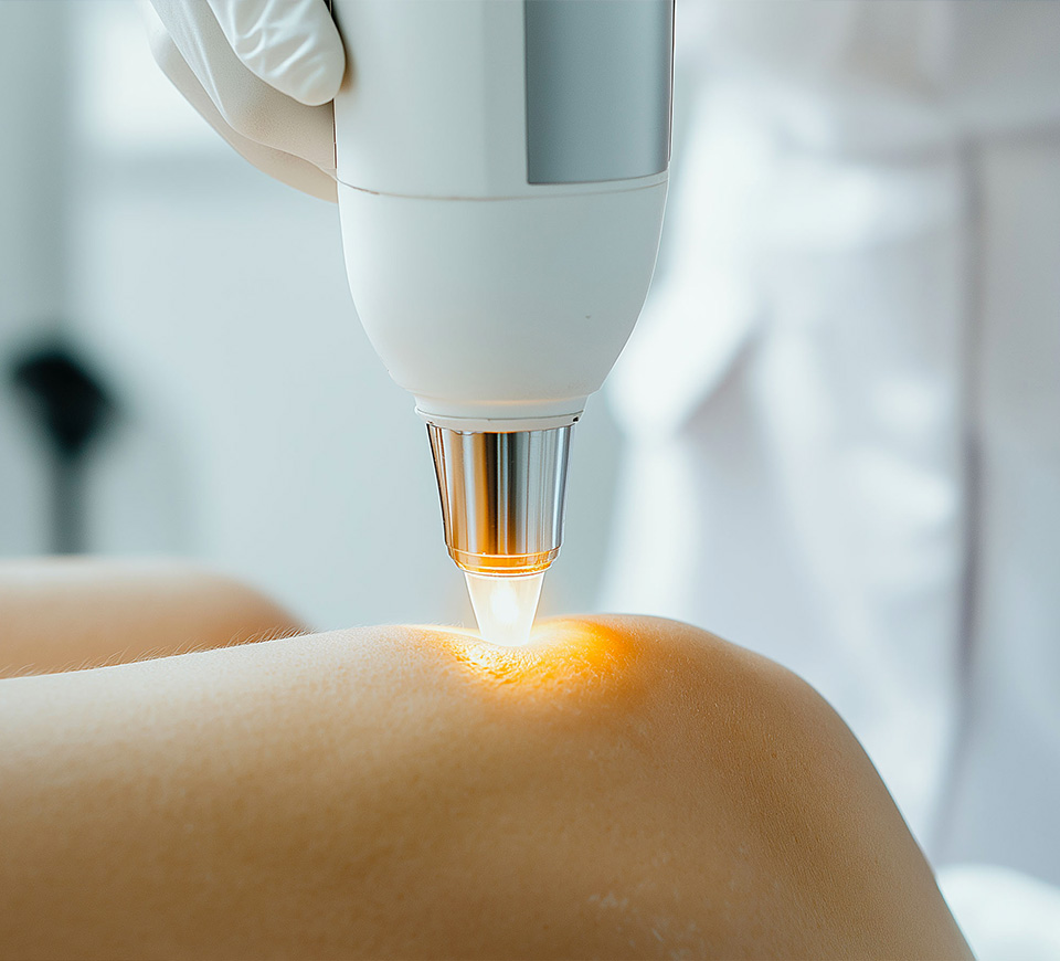 laser vasculaire