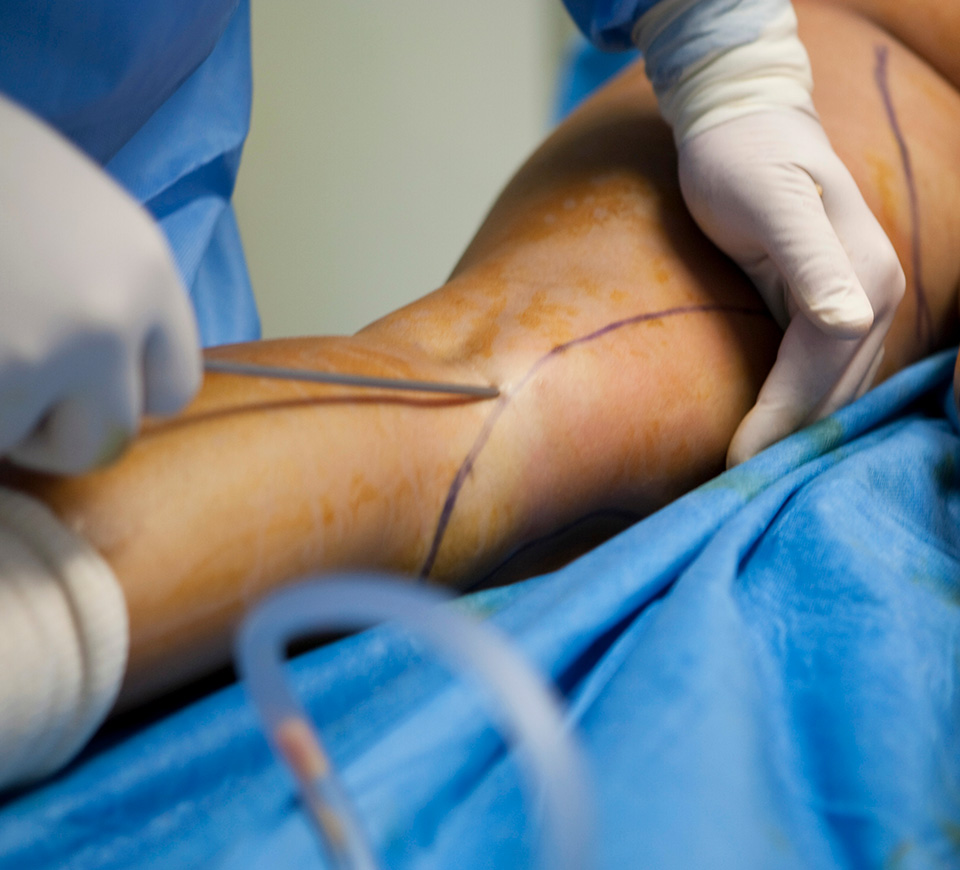 liposuccion genoux