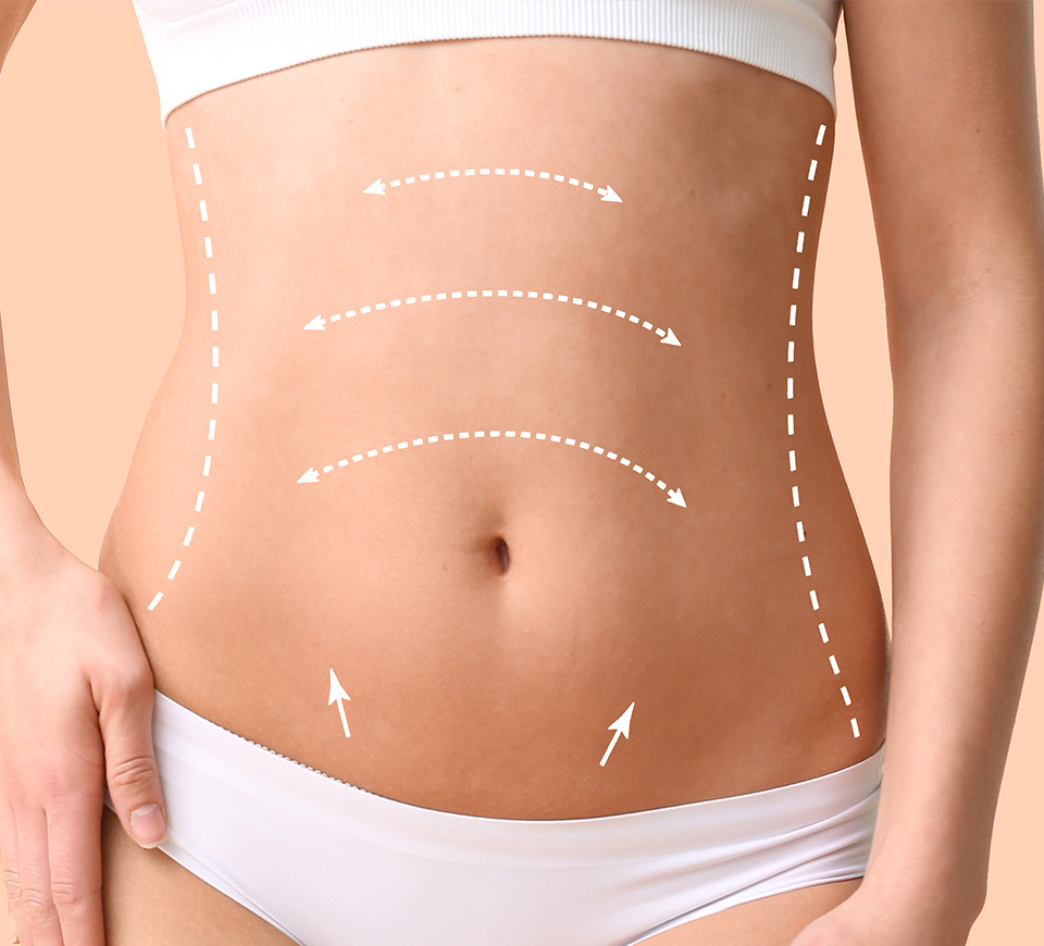 liposuccion ventre
