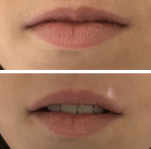 Acide hyaluronique - Patiente 1