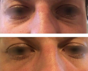 acide hyaluronique - avant/après