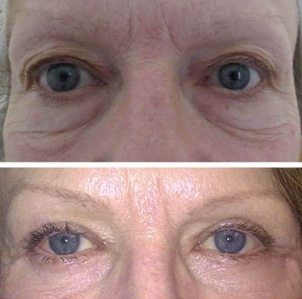 Blépharoplastie - Patient 3