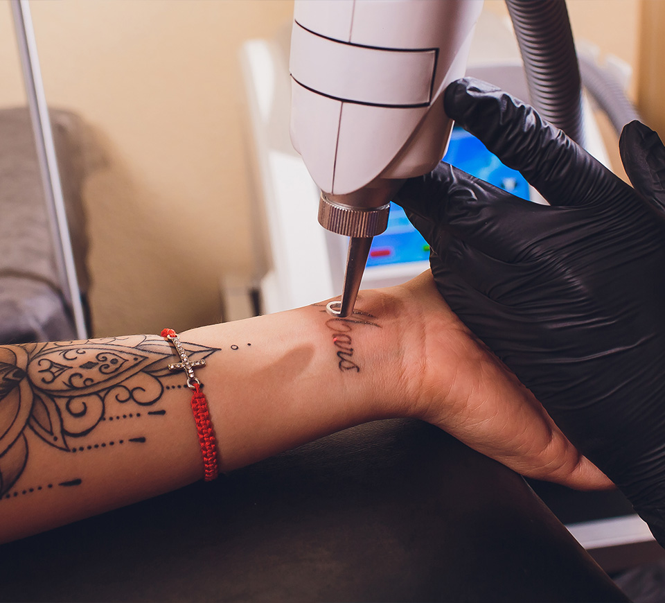 Détatouage par laser