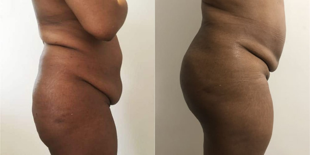 Lipofilling fessier - Patiente 1 profil