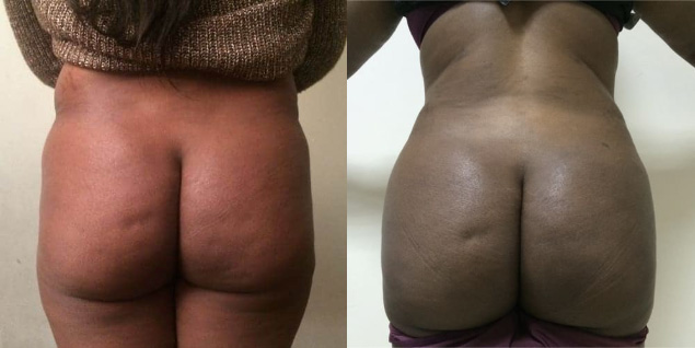 Lipofilling fessier - Patiente 1 dos