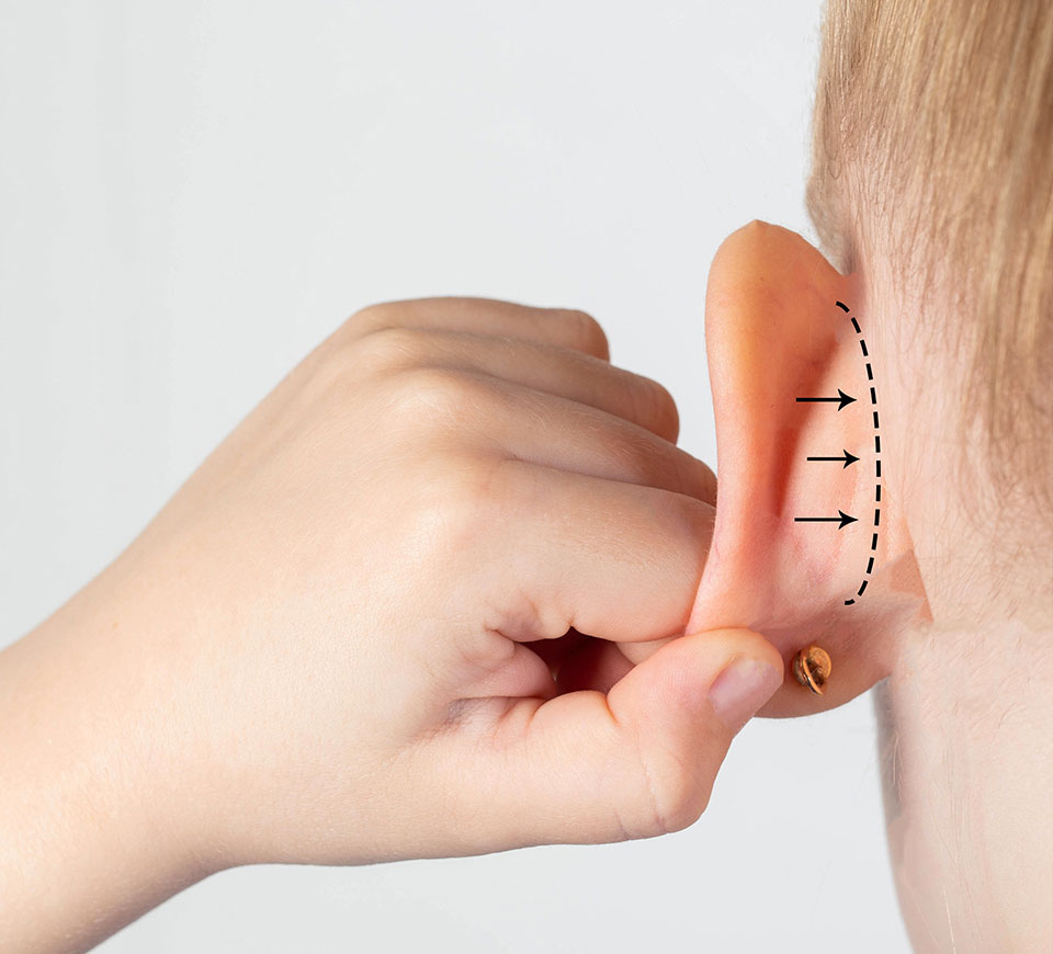 Otoplastie (oreilles décollées)