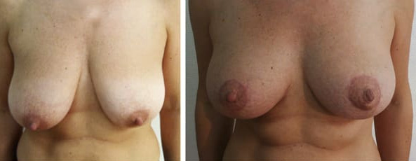 Ptose mammaire - Patient 3