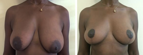 Ptose mammaire - Patient 6