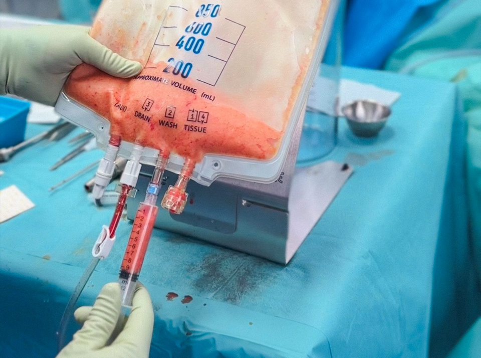 Lipofilling seins