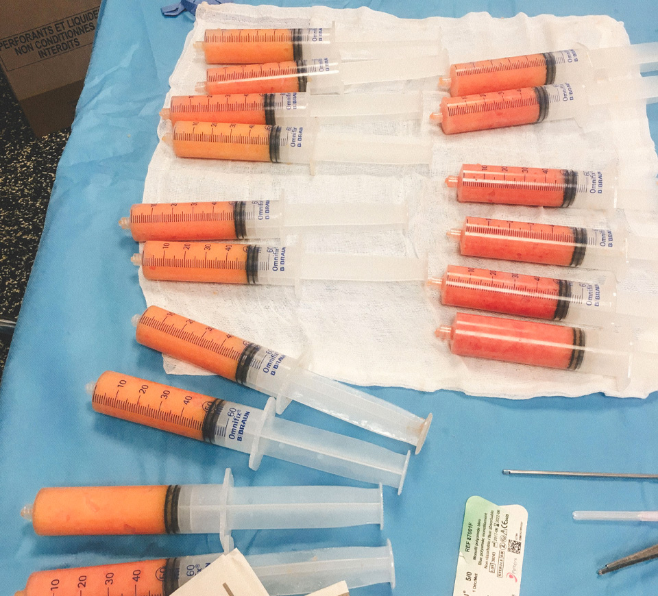 lipofilling seins injection