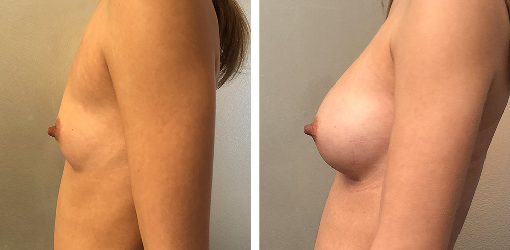 Augmentation mammaire par prothèses - Patiente 2