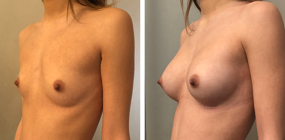 Augmentation mammaire par prothèses - Patiente 2