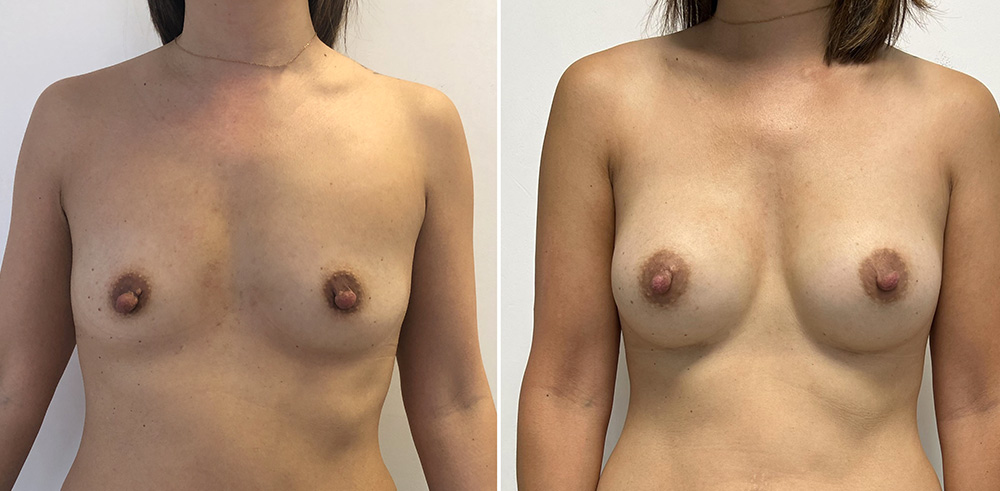 Augmentation mammaire par prothèses - Patiente 4