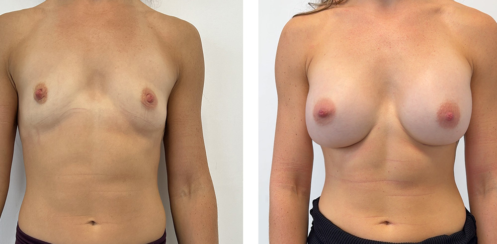 Augmentation mammaire par prothèses - Patiente 6