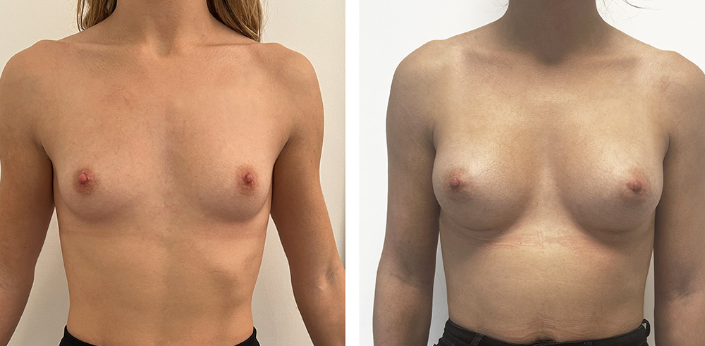 Augmentation mammaire par prothèses - Patiente 7