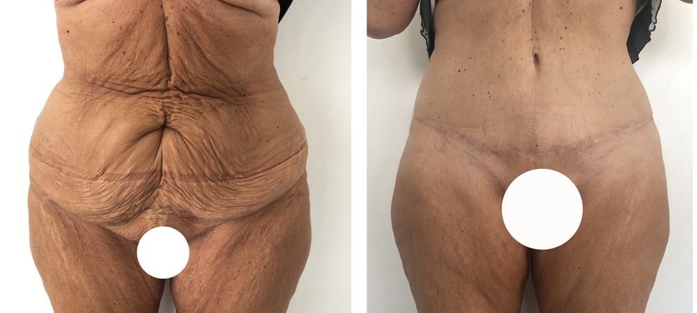 Abdominoplastie avant/après