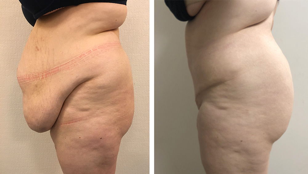 Abdominoplastie avant/après