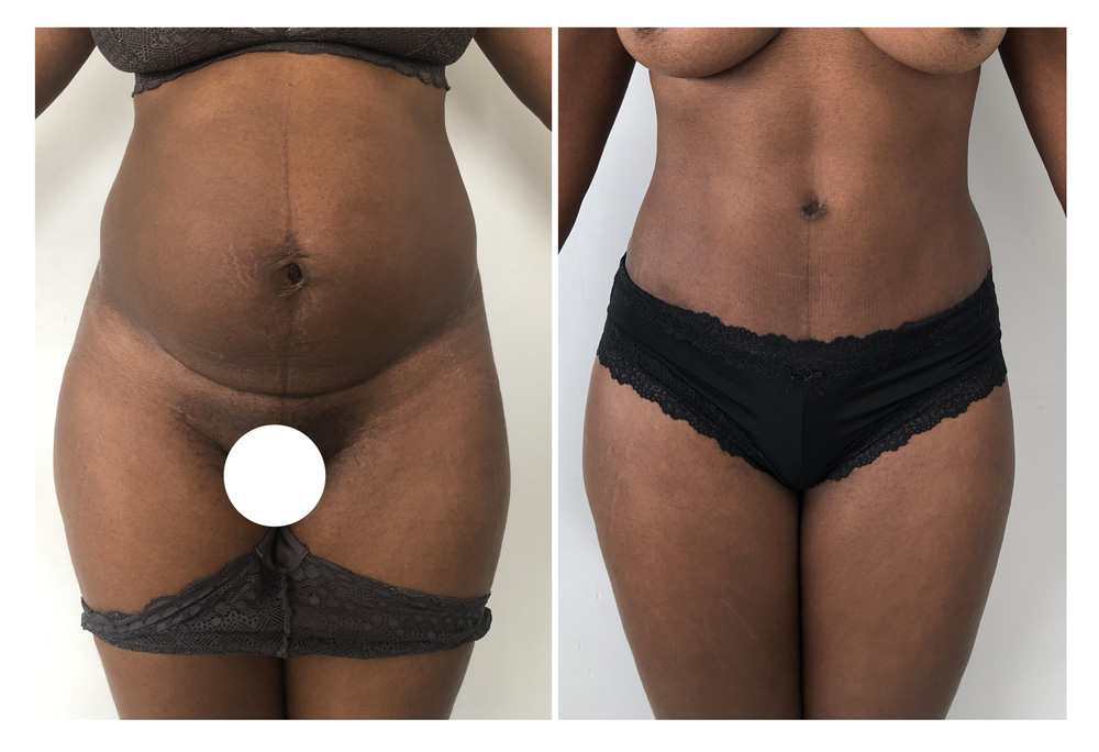 Abdominoplastie avant/après