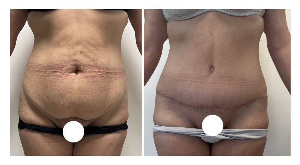Abdominoplastie avant/après