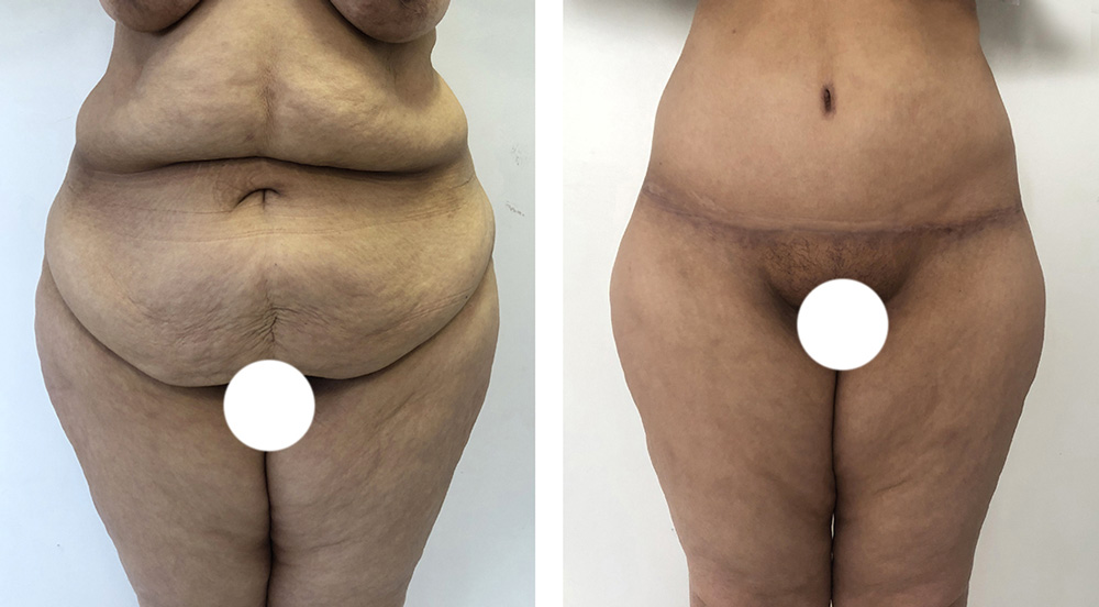 Abdominoplastie avant/après