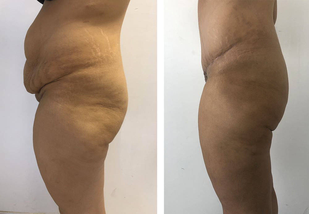 Abdominoplastie avant/après