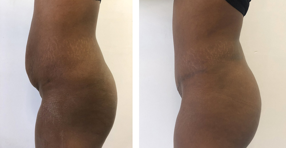 Abdominoplastie avant/après