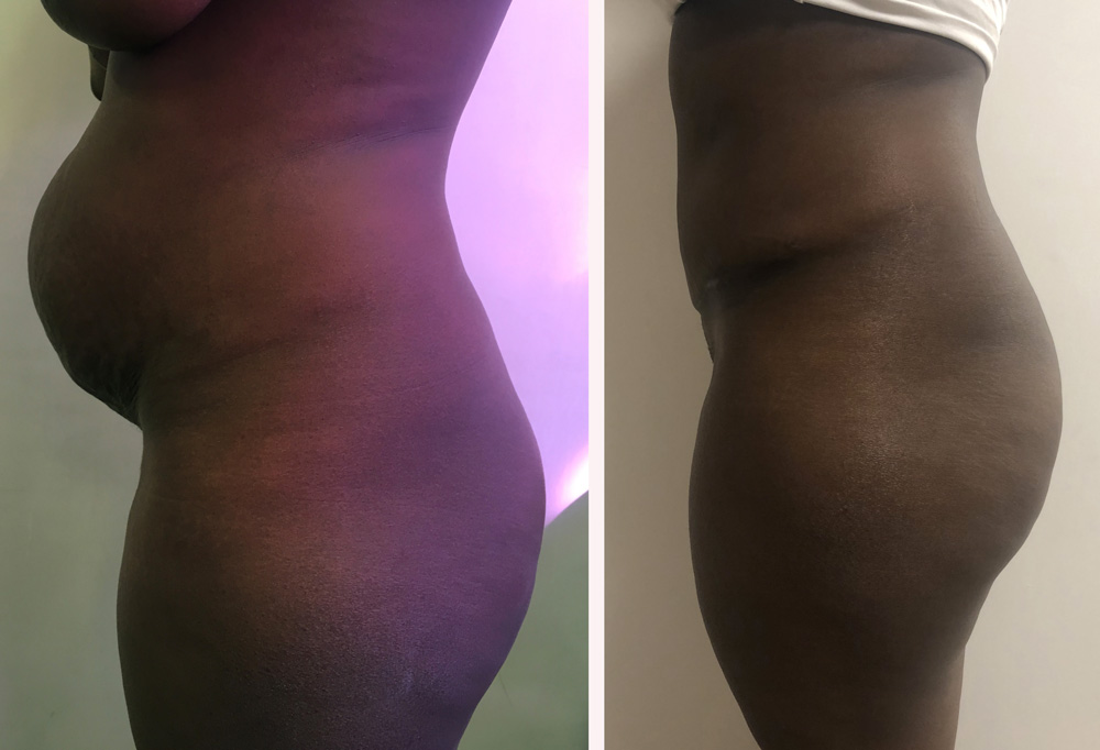 Abdominoplastie avant/après