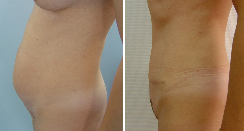 Abdominoplastie avant/après