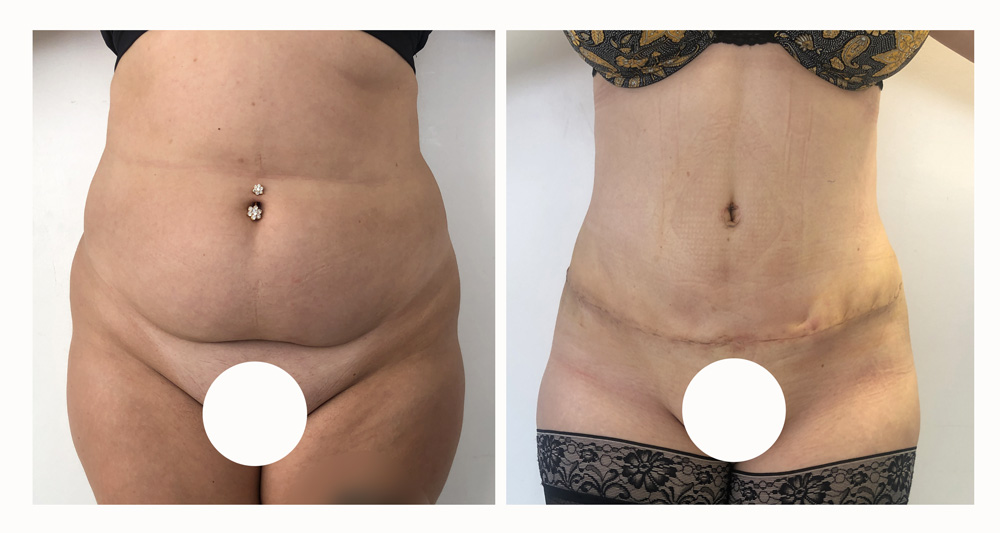 Abdominoplastie avant/après