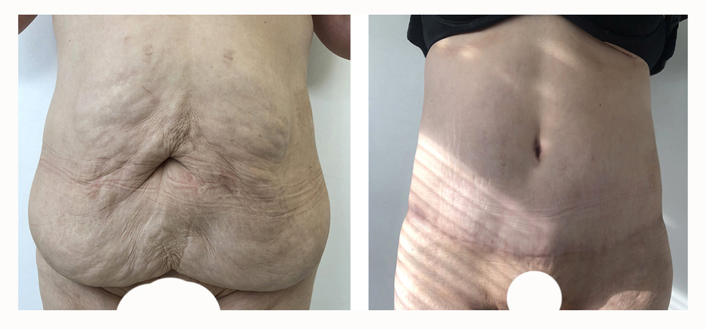 Abdominoplastie - Patiente 16