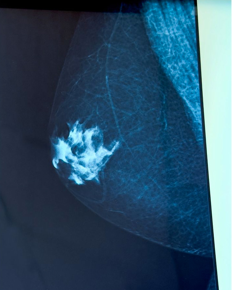 gynecomastie aspect mammographie