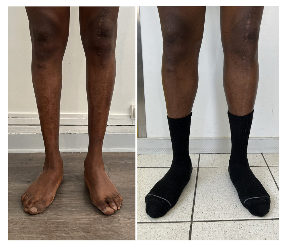 Augmentation du mollet - Patient 01