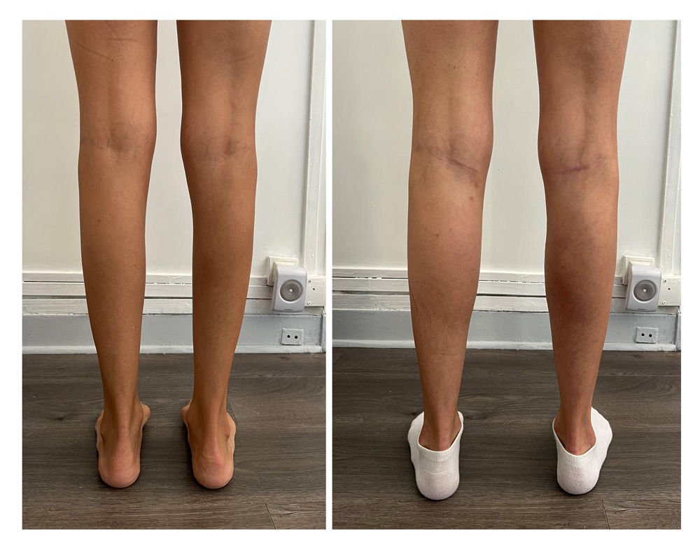 Augmentation du mollet - Patient 02